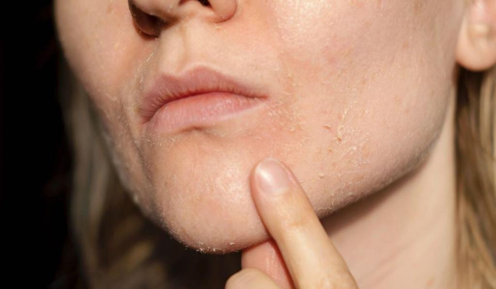A womans face peeling from a chemical peel